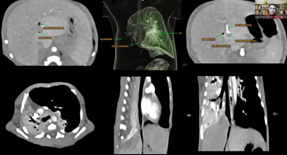 1st Place: Challenging Case of Congenital Bronchoabdominal Fistula